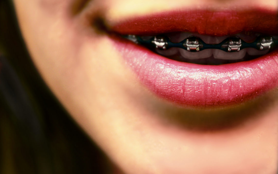 woman's mouth with braces