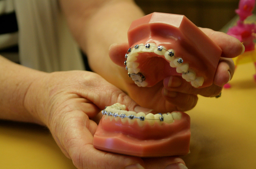 hands holding a model of teeth with braces