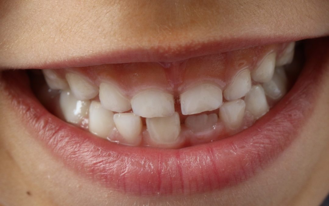 Pediatric Dentistry – The Health of Baby Teeth